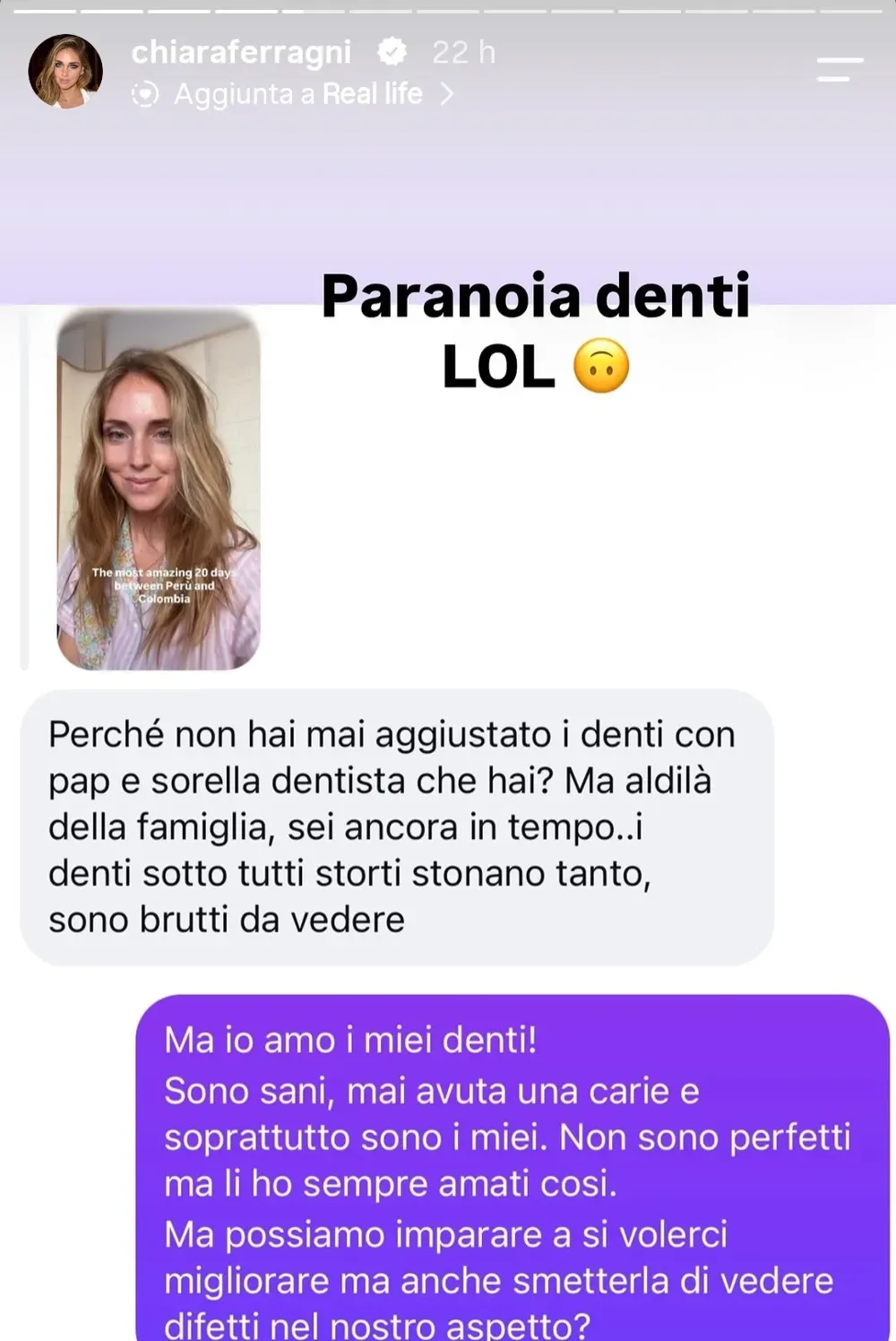 Chiara Ferragni e la risposta al follower che le chiede perch non si sia mai rifatta i denti