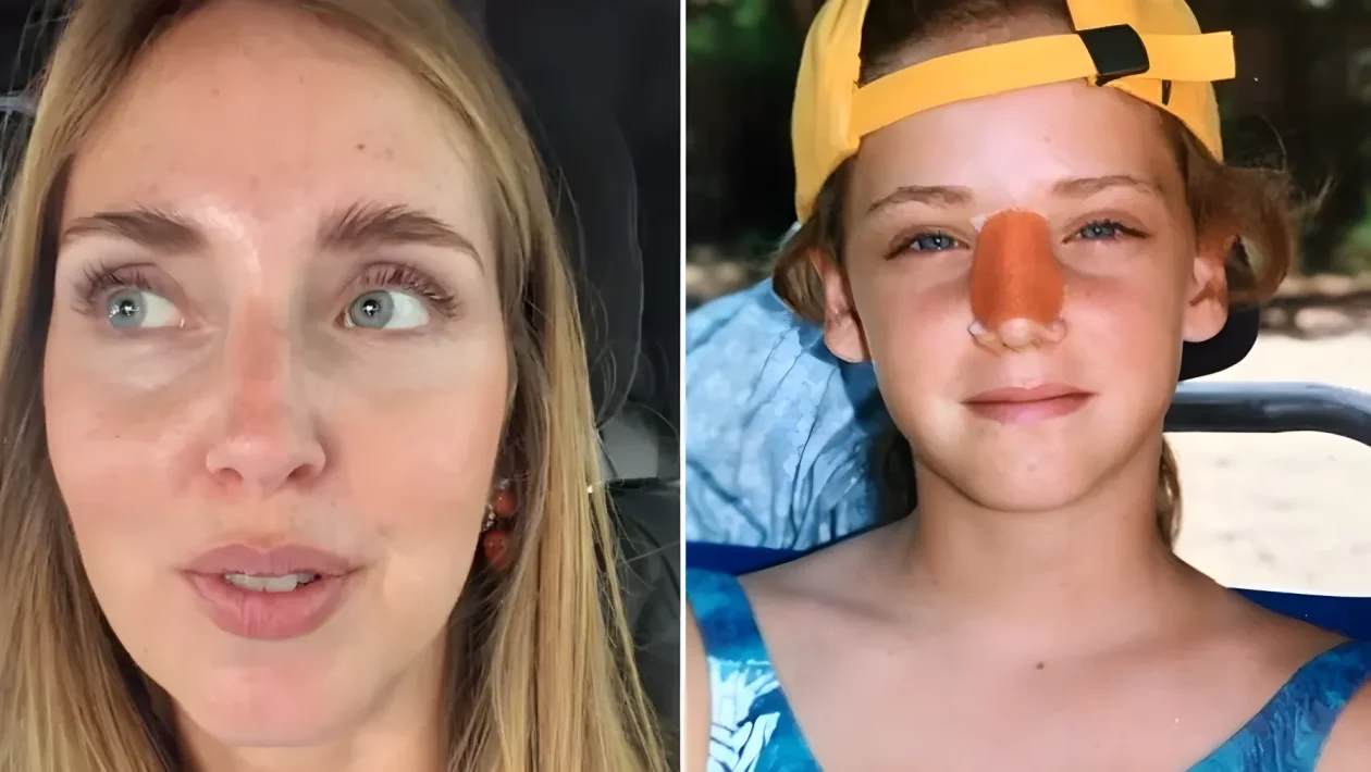 Chiara Ferragni mostra lo scatto a 10 anni: l'incidente a Maui e l'intervento al naso