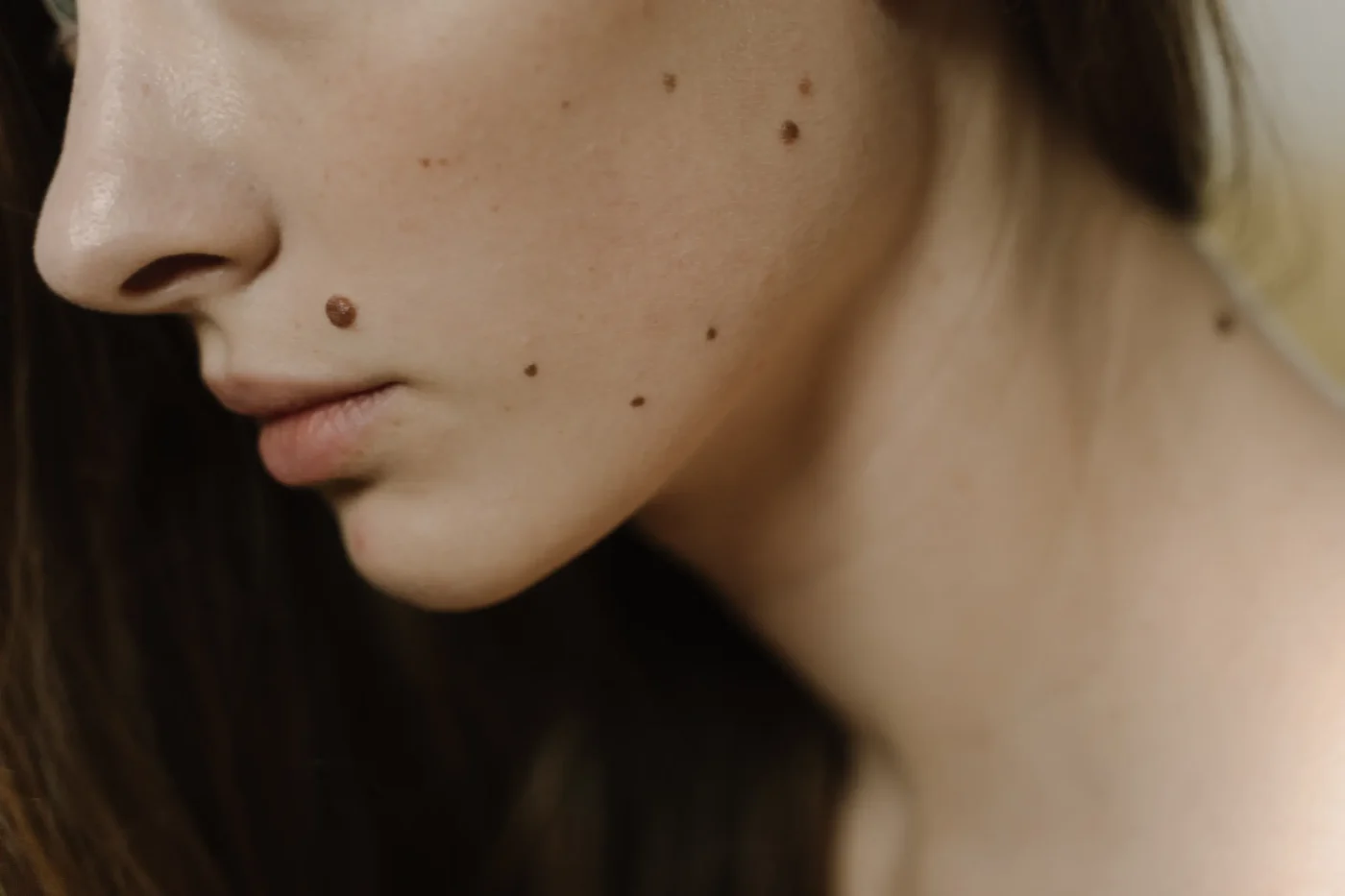 Melanoma e prevenzione: sfatare i luoghi comuni